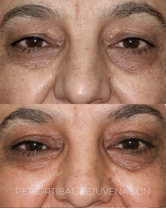Periorbital Rejuvenation before and after