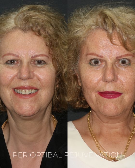 Periorbital Rejuvenation before and after
