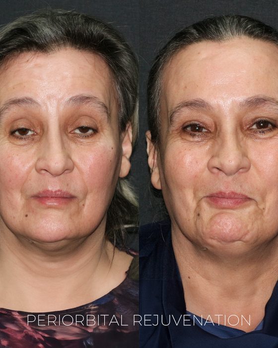 Periorbital Rejuvenation before and after