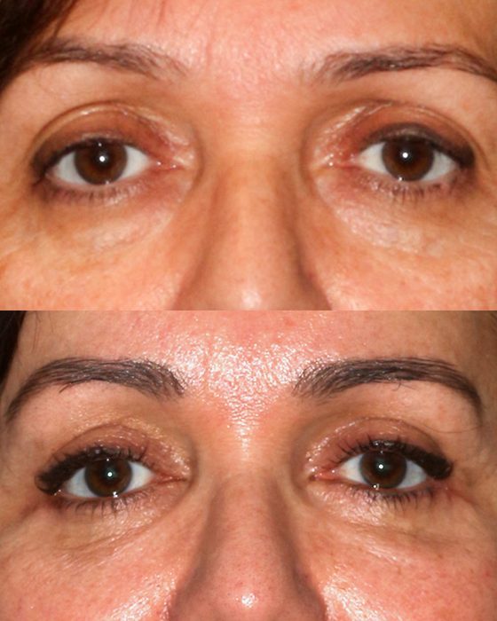Upper & Lower Blepharoplasty before and after