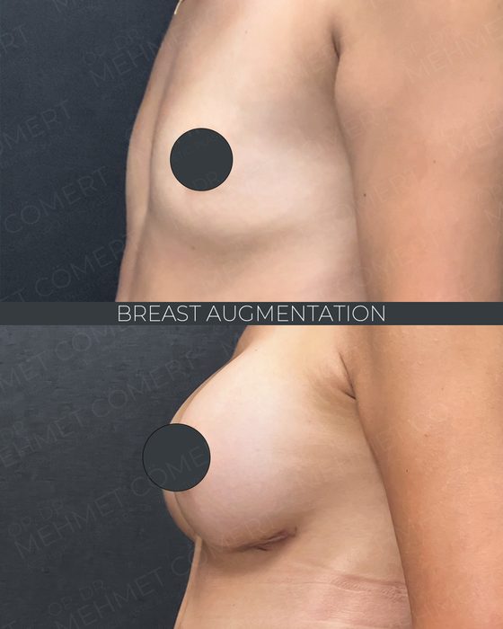 Breast Augmentation before and after