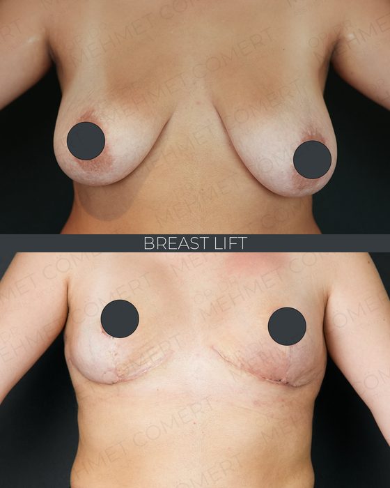 Breast Lift (Mastopexy) before and after