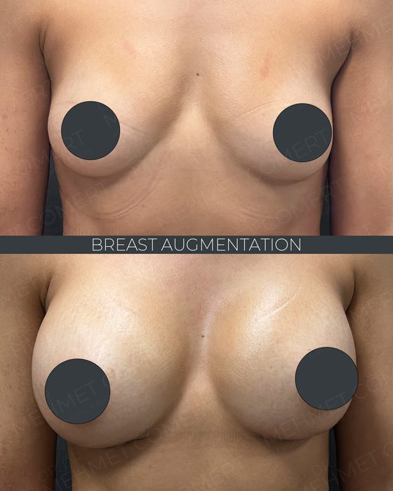 Breast Augmentation before and after