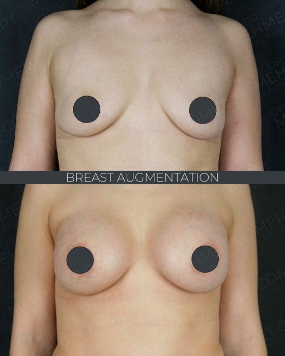 Breast Augmentation before and after