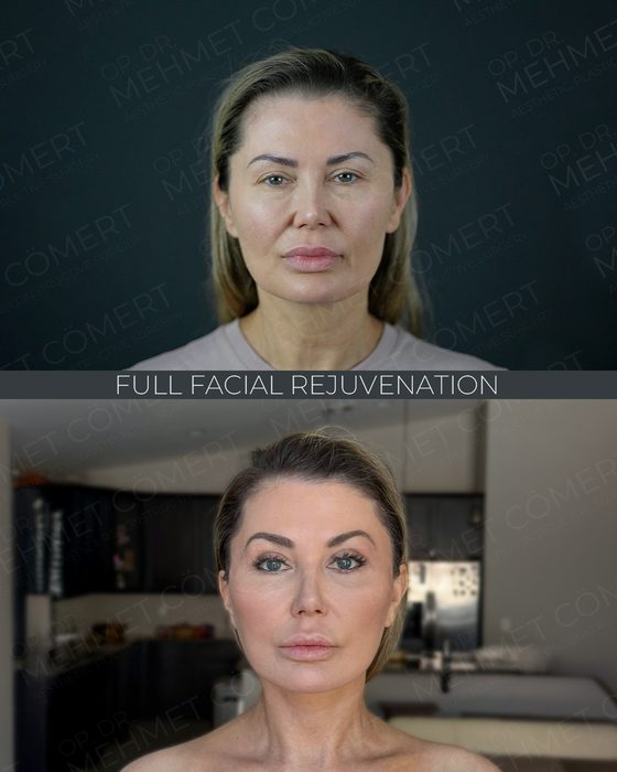 Full Facial Rejuvenation before and after