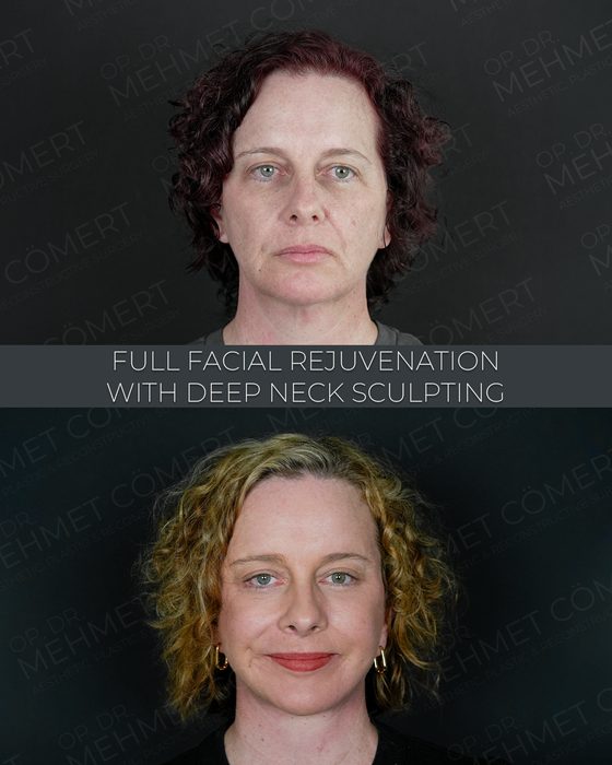 Full Facial Rejuvenation + Deep Neck Sculpting before and after