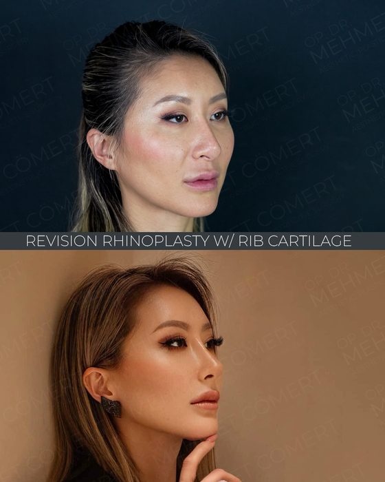 Revision Rhinoplasty w/ Rib Cartilage before and after