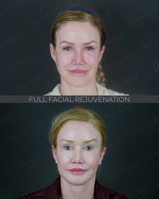 Full Facial Rejuvenation before and after