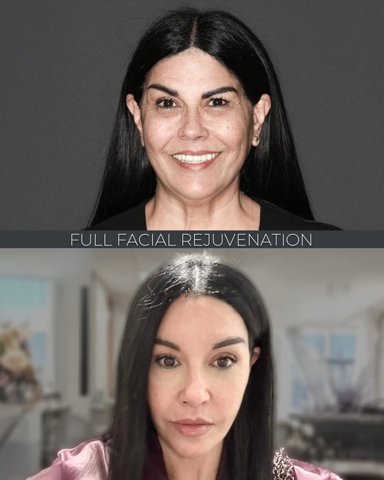 Full Facial Rejuvenation before and after