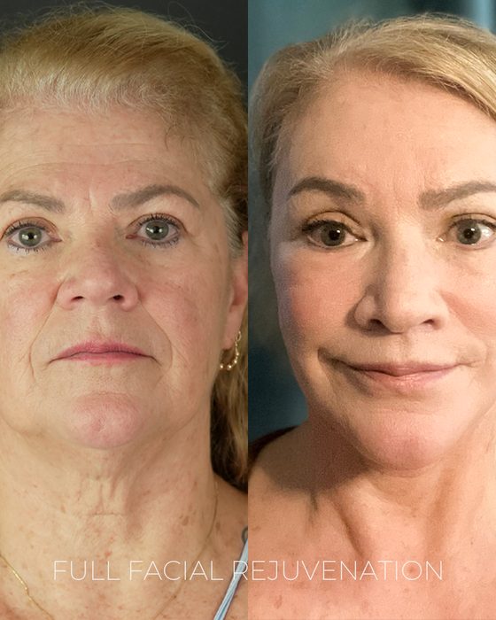 Full Facial Rejuvenation before and after