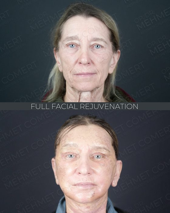 Full Facial Rejuvenation before and after