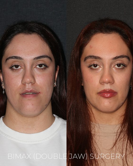 Bimax (Double Jaw) Surgery before and after