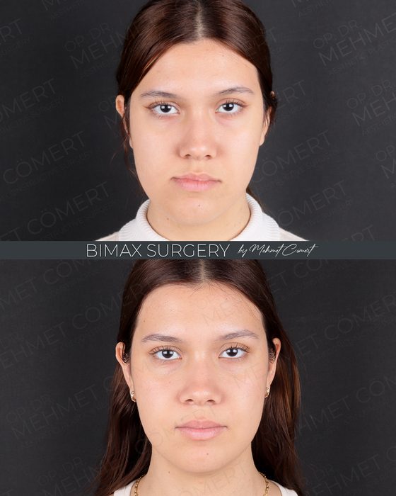 Bimax Surgery before and after