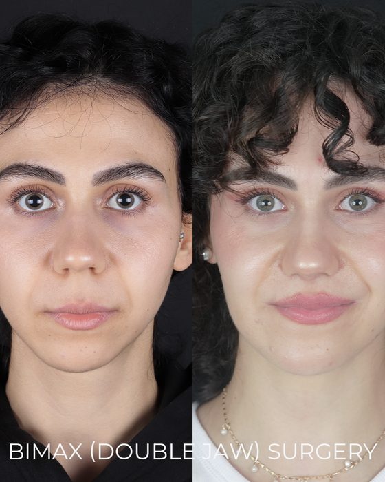 Bimax (Double Jaw) Surgery before and after