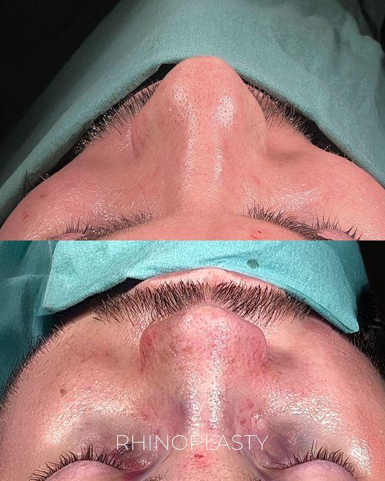 Rhinoplasty before and after