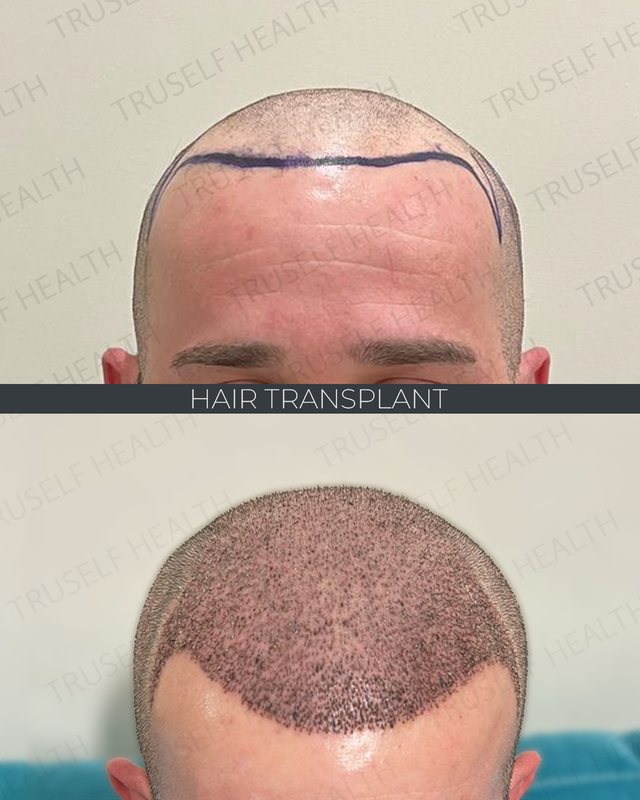 Hair transplant result