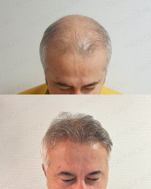 Hair transplant result